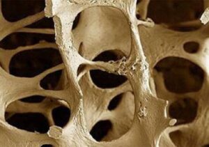 عارض يظهر بوضوح في الصباح يشير إلى هشاشة العظام