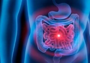 متلازمة الأمعاء المتسربة وأعراضها؟